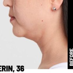Ultherapy Before & After Patient #1546